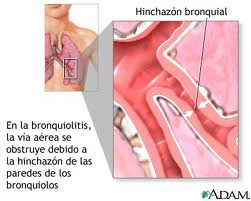 La bronquilitis