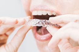 Invisalign: Todo lo que debes saber